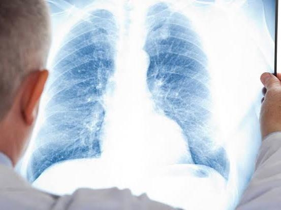 El cáncer de pulmón se mantiene entre los más letales y silenciosos